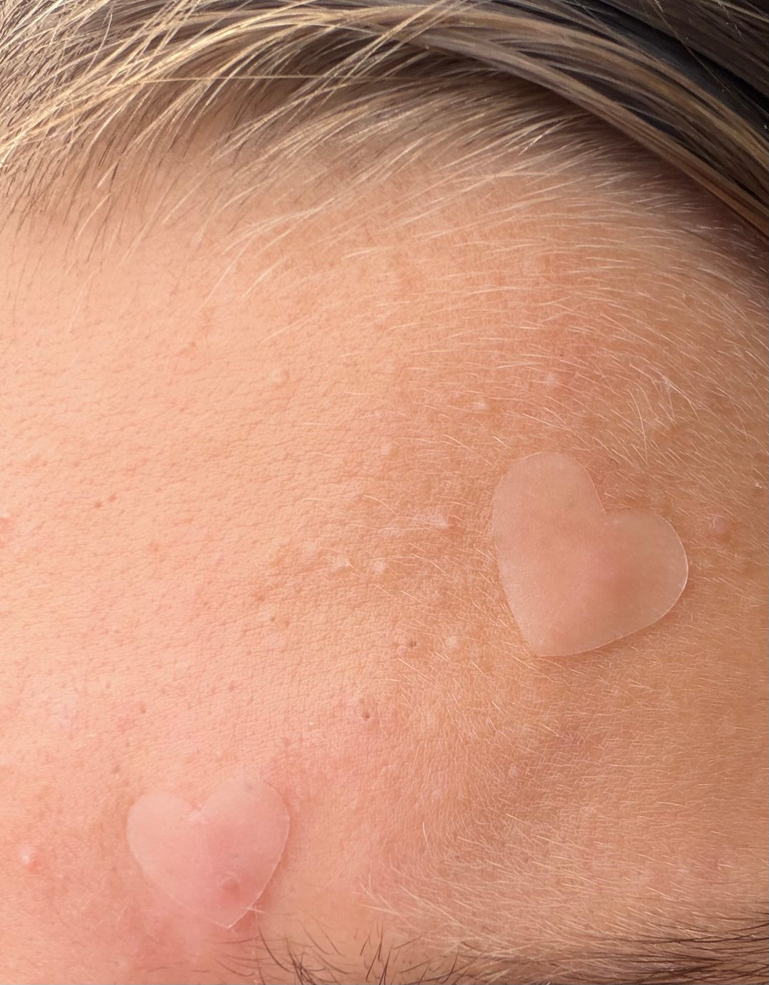 Magic CLEAR heart pimple patches - jumbo pack